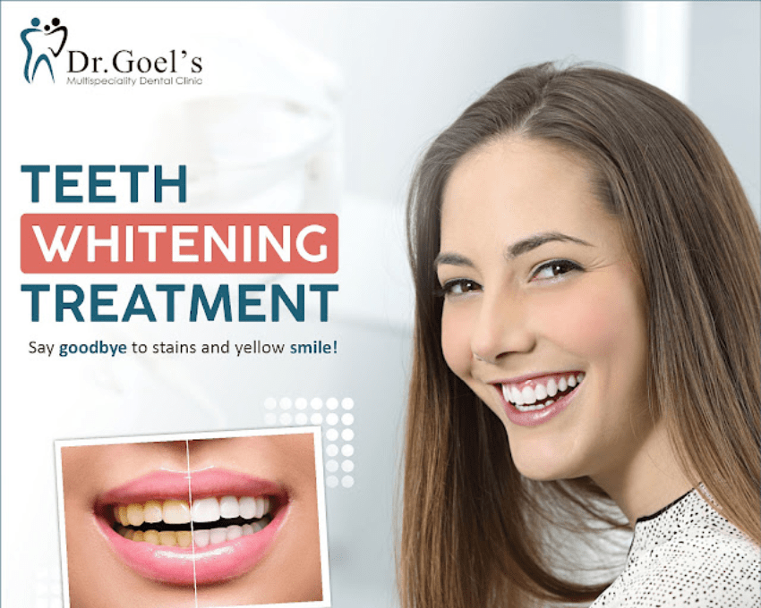 Zoom Teeth Whitening Benefits and Smile Designing in Gurgaon