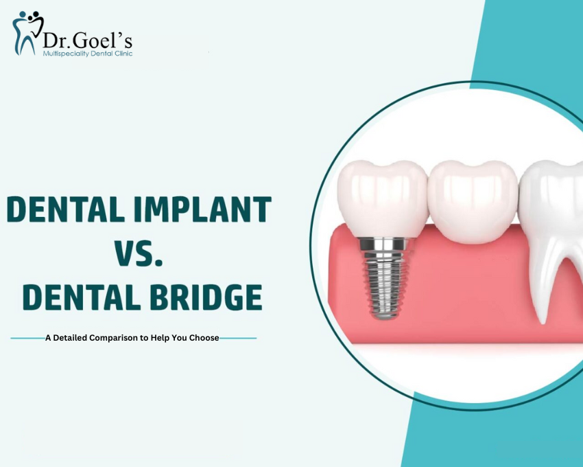Dental Implants Vs Bridges A Detailed Comparison to Help You Choose