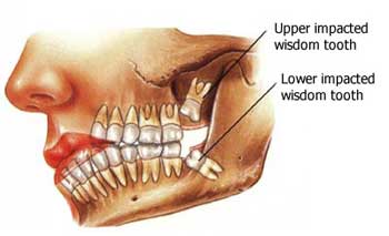 Wisdom Tooth Extraction